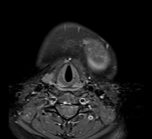 T1 Fat Saturated Post Contrast image of neck