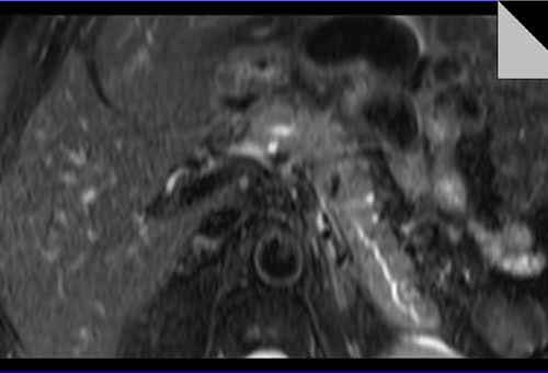 T2 fat Saturated axial sequence used in pancreas imaging.