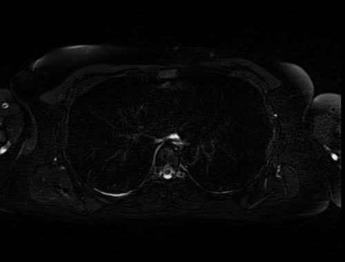 STIR axial sequence used in chest imaging