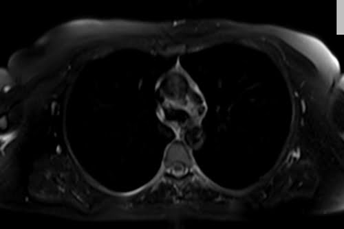T2 fat Saturated axial sequence used in chest imaging.