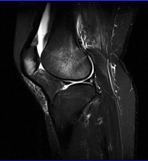 STIR sagittal sequence used in knee imaging