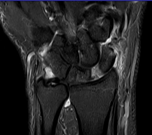 STIR coronal sequence used in wrist imaging