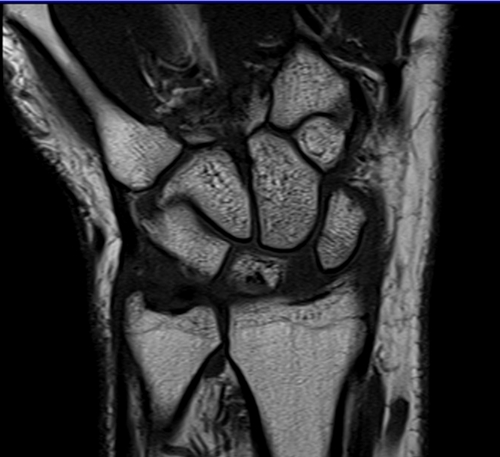 MRI wrist coronal t1 image 2