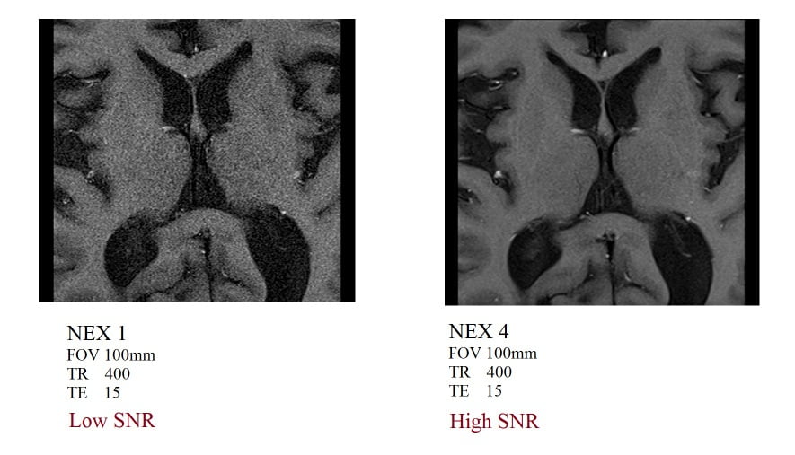 Number of excitations (NEX) or NSA and SNR relation in MRI