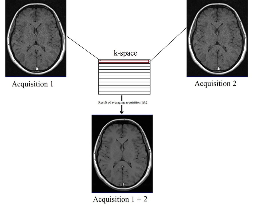 Number of signal averages (NSA) or number of excitations (NEX) in MRI