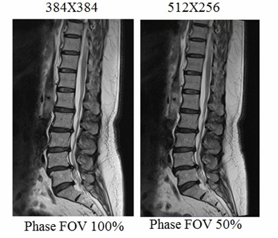 PHASE FOV MANIPULATION MRI
