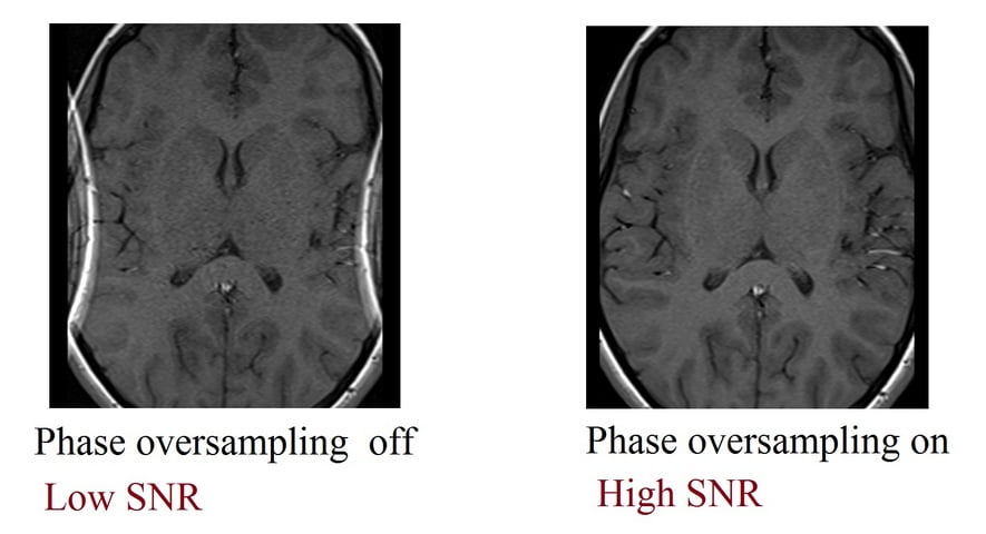 Phase oversampling (No phase-wrap )and SNR relation in MRI