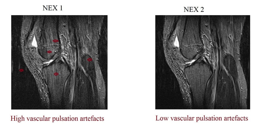 Relation between NEX and motion artifacts (physical movements, respiration, peristalsis and vascular pulsation) in MRI