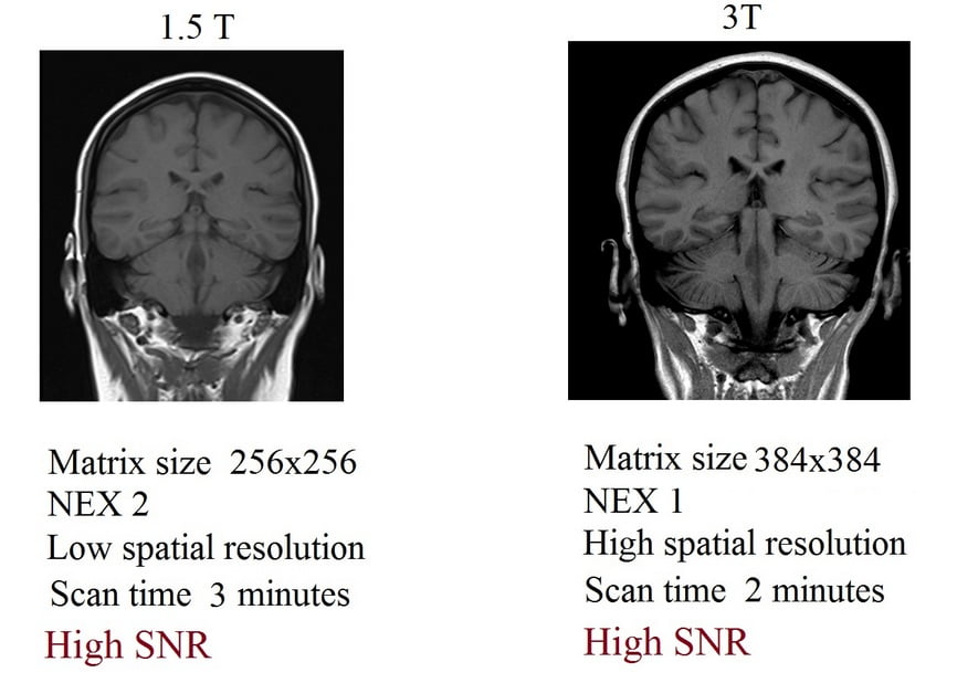 SNR comparison of 3T and 1.5 images
