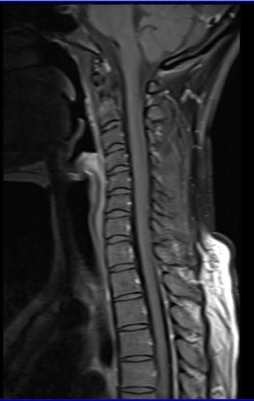 T1 Fat Saturated Post Contrast image of cervical spine