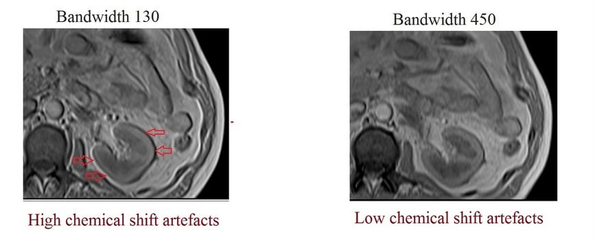 chemical shift artefacts and bandwidth in MRI