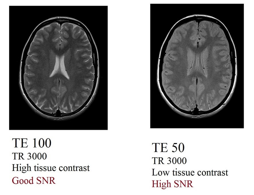 echo time (TE) and SNR relation in MRI