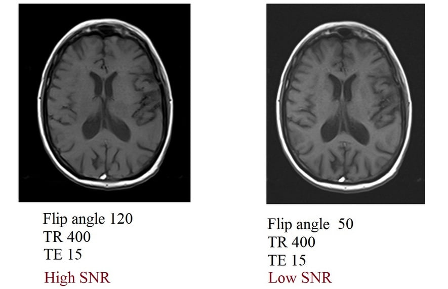 flip angle and SNR relation in MRI