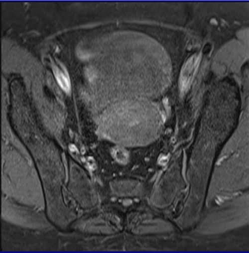 T1 Fat saturated image of female pelvis