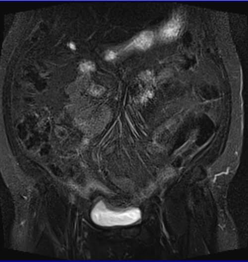 STIR coronal sequence used in abdominal imaging