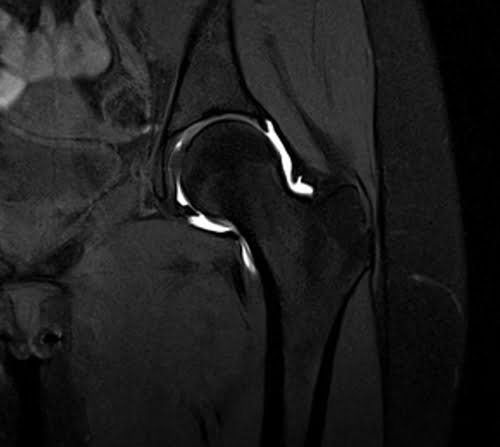 T1 Fat Saturated Post Contrast image of hip