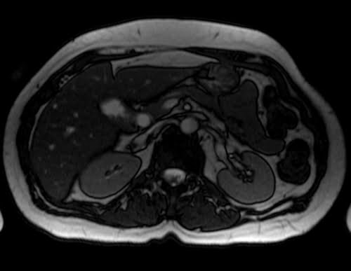 True FISP axial sequence used in abdomenal imaging