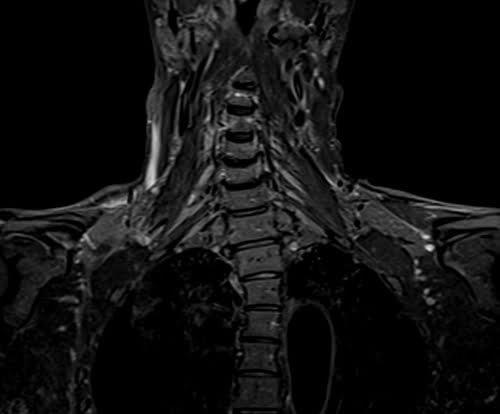 STIR coronal sequence used in b plexus imaging