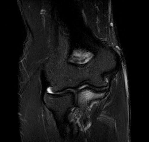 STIR coronal sequence used in elbow imaging