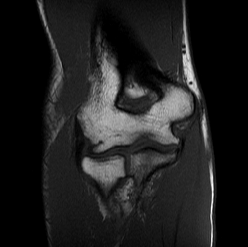 MRI elbow coronal T1 image