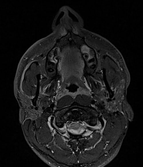STIR axial sequence used in face imaging
