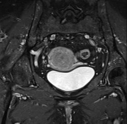 T1 Fat Saturated Post Contrast image of pelvis