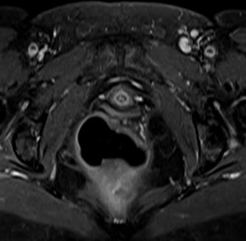 T1 Fat Saturated Post Contrast image of female pelvis