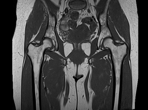 MRI hips coronal t1 image