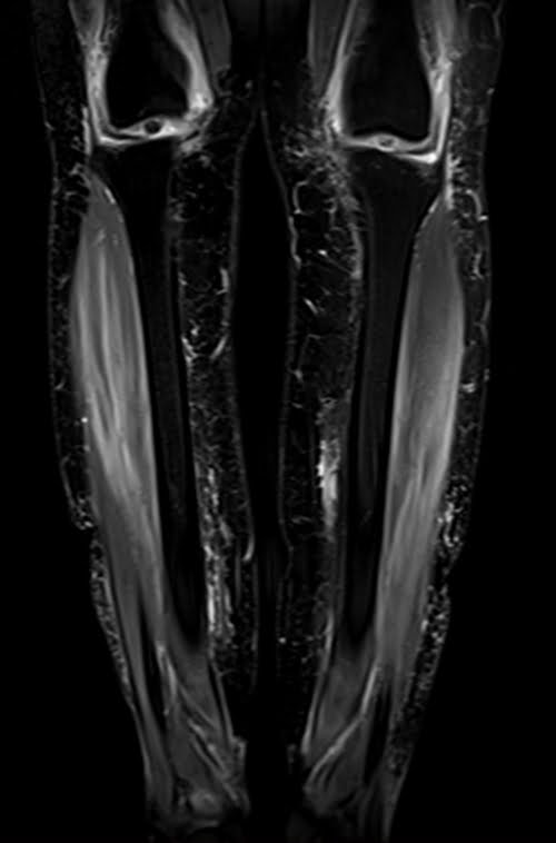STIR coronal sequence used in lower legs imaging