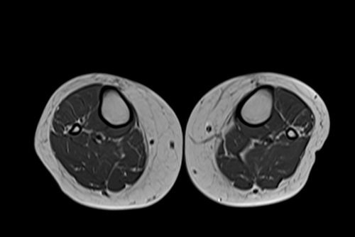 MRI lower legs (calves) T1 axial image