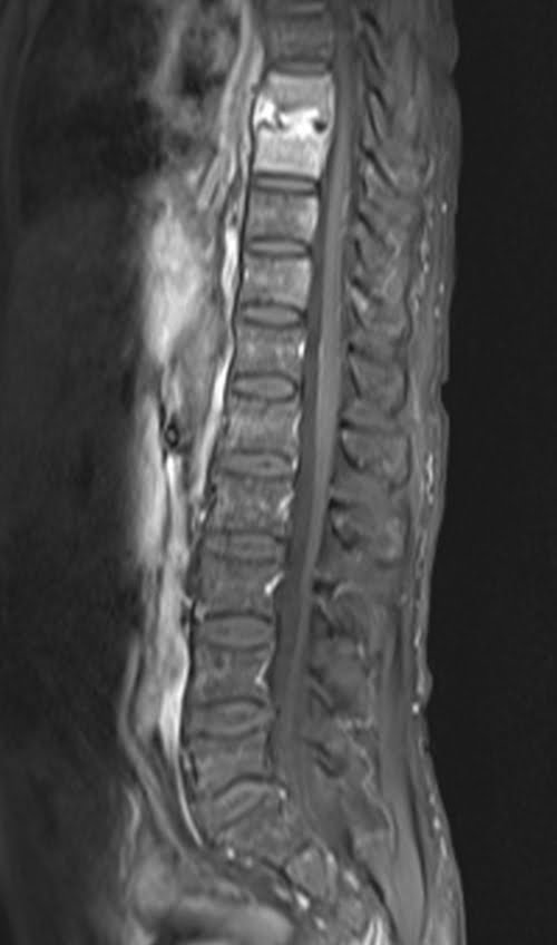 T1 Fat Saturated Post Contrast image of lumbar spine