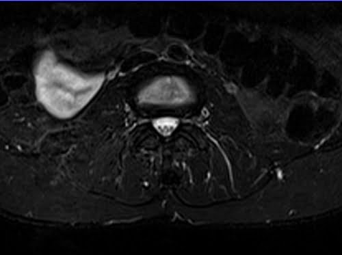 STIR axial sequence used in L plexus imaging