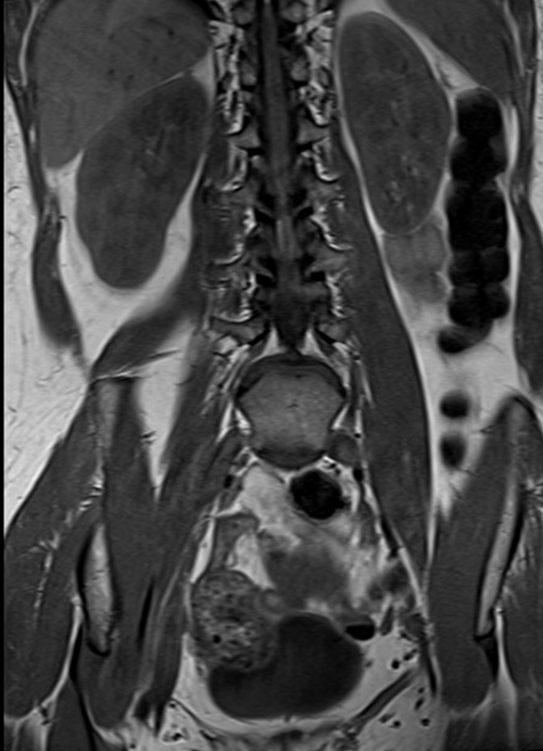 MRI lumbosacral plexus coronal T1 image