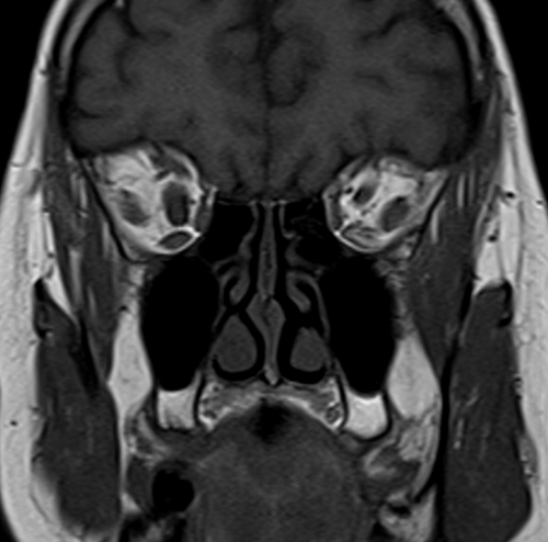 MRI T1 orbits coronal image