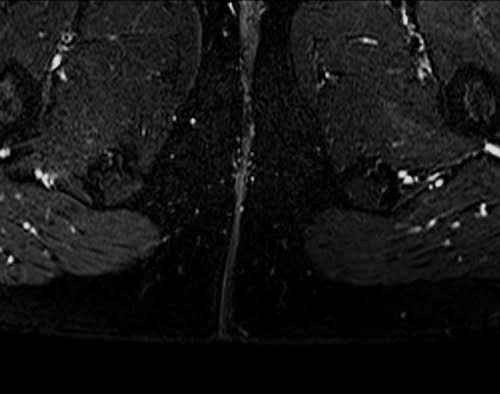T2 fat Saturated axial sequence used in pelvis fistula imaging.
