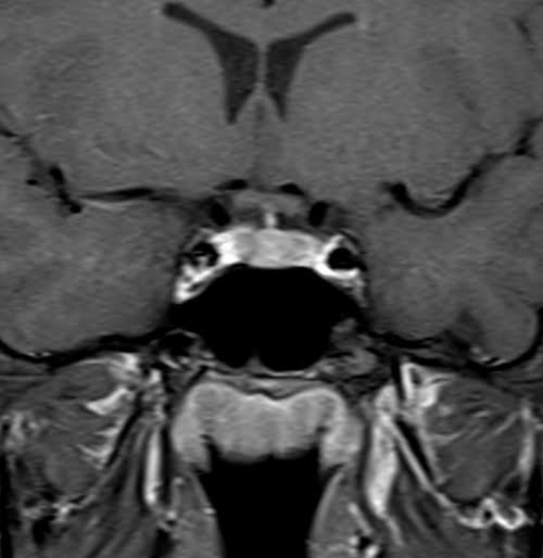 T1 Fat Saturated Post Contrast image of pituitary gland
