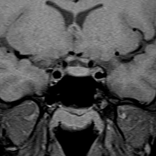 T1 Fat saturated image of pituitary