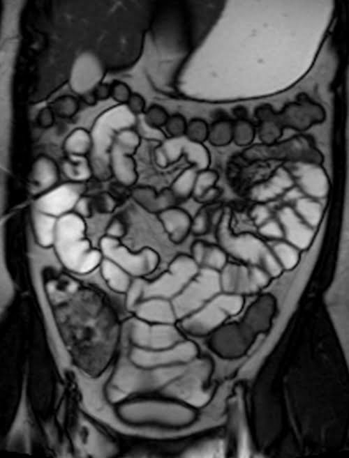 True FISP coronal sequence used in enterography mri imaging