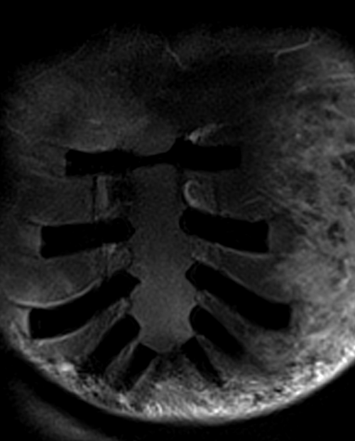 STIR coronal sequence used in sternum imaging