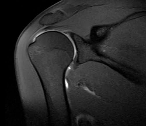 T1 Fat Saturated Post Contrast image of shoulder