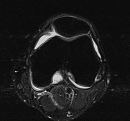 T2 fat Saturated axial sequence used in knee imaging.