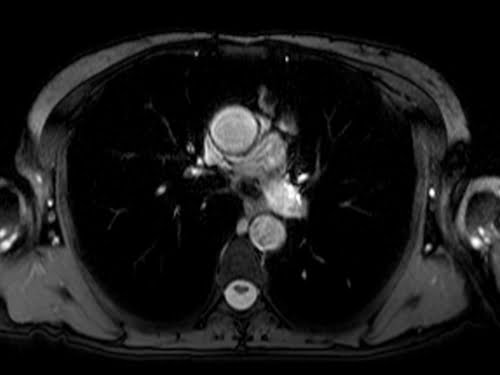 True FISP axial sequence used in chest imaging