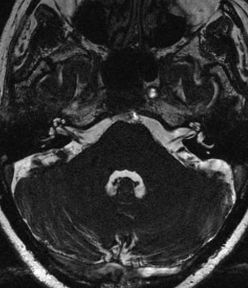 Axial CISS sequence used in IAM's imaging
