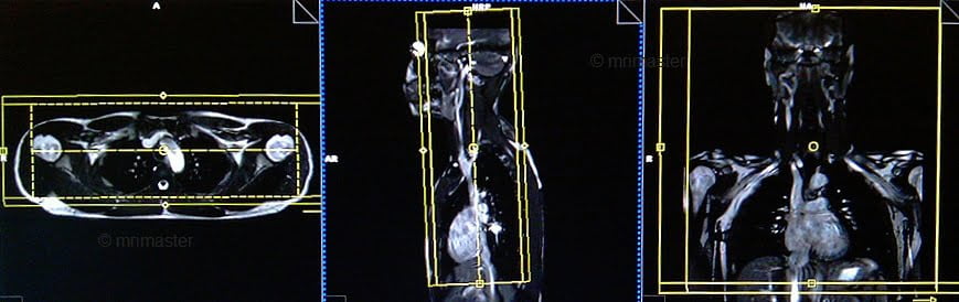 magnetic resonance angiography(MRA) whole body protocols and planning of chest and neck post contrast scans