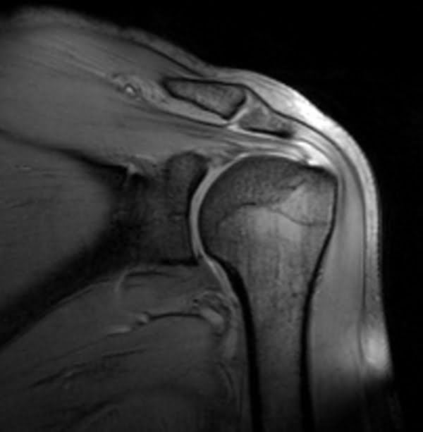 Coronal MEDIC sequence used in shoulder imaging