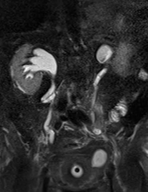 HASTE fat saturated coronal sequence used in urography imaging