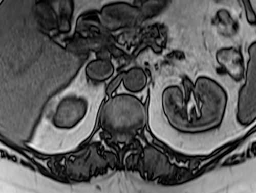 VIBE axial sequence used in adrenal gland imaging