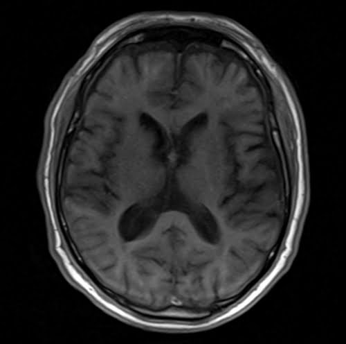 flash axial sequence used in uncooperative patients brain imaging