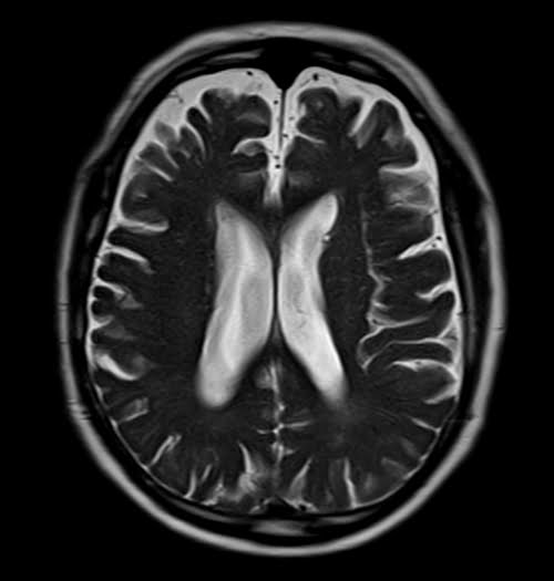 HASTE axial 5 mm sequence used in uncooperative patients brain imaging