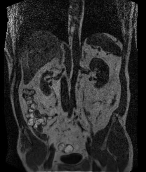 FLASH MRI Abdomen image